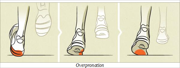 Overpronation on Your Foot Can Affect Other Parts of Your Body