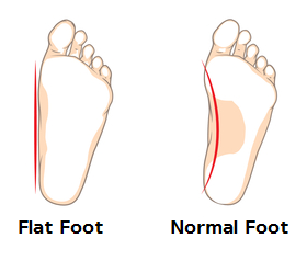 Flat Foot and Normal Foot