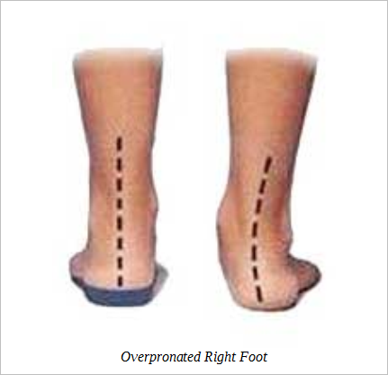 overpronated-right-foot